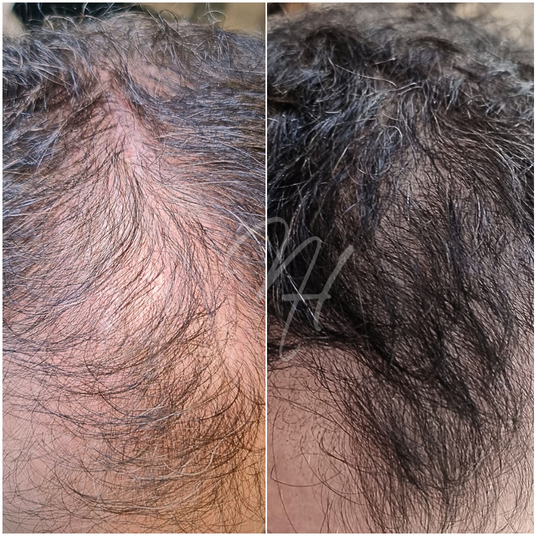 Dauerhafte Haarentfernung